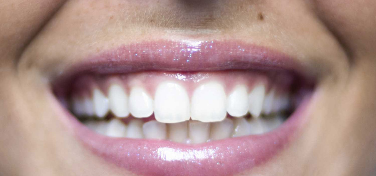 sbiancamento denti, sorriso, dentista figlioli palermo