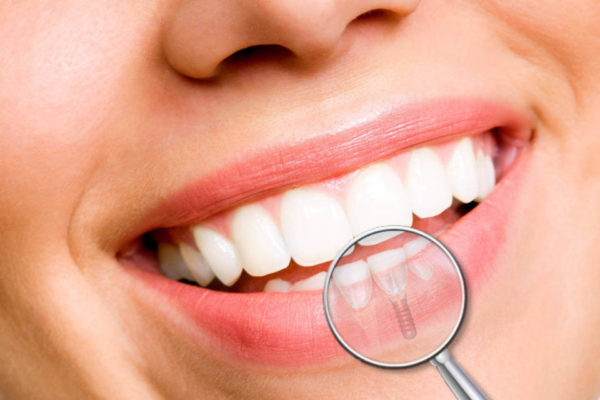 implantologia-dentale implantologia dentale