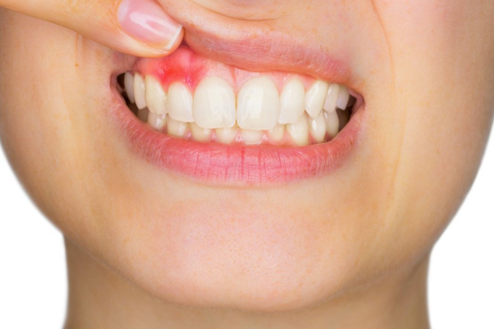 sanguinamento-gengivale sanguinamento gengivale