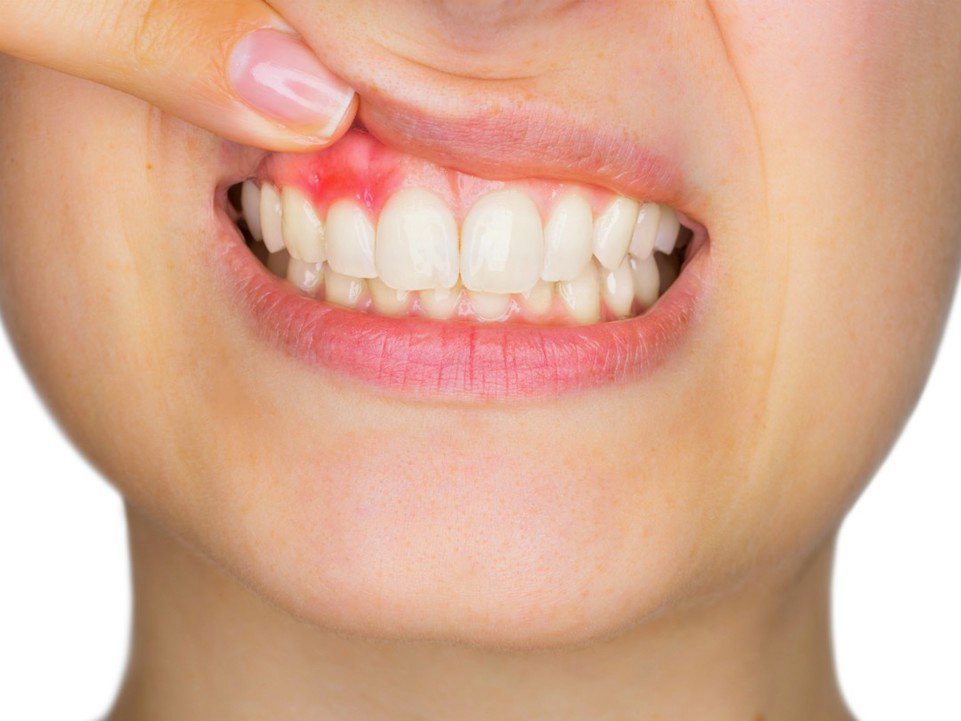 sanguinamento-gengivale sanguinamento gengivale